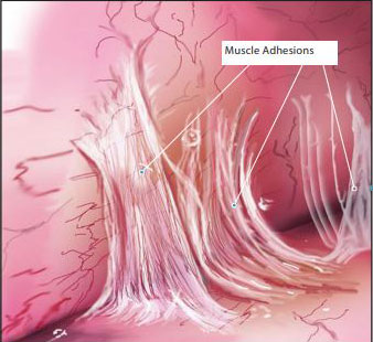 Muscle Adhesions